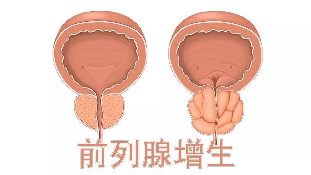 前列腺增生